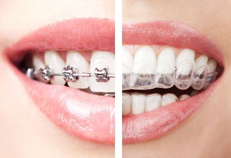 Orthodontic Treatments (Braces & Aligners)